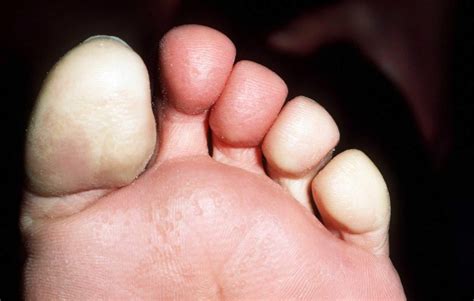 Raynauds Disease: Feet Pictures,。